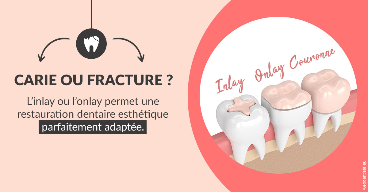 https://selarl-cabinet-dentaire-pujol.chirurgiens-dentistes.fr/T2 2023 - Carie ou fracture 2