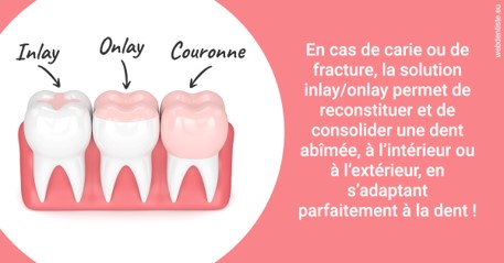 https://selarl-cabinet-dentaire-pujol.chirurgiens-dentistes.fr/L'INLAY ou l'ONLAY 2