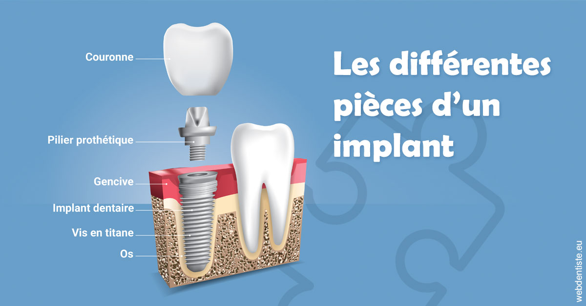 https://selarl-cabinet-dentaire-pujol.chirurgiens-dentistes.fr/Les différentes pièces d’un implant 1